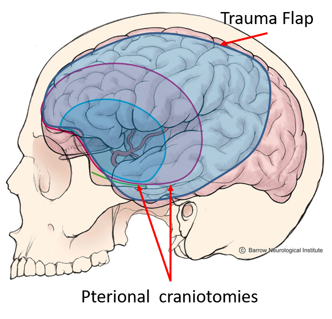 Trauma Flap / Hemicraniectomy