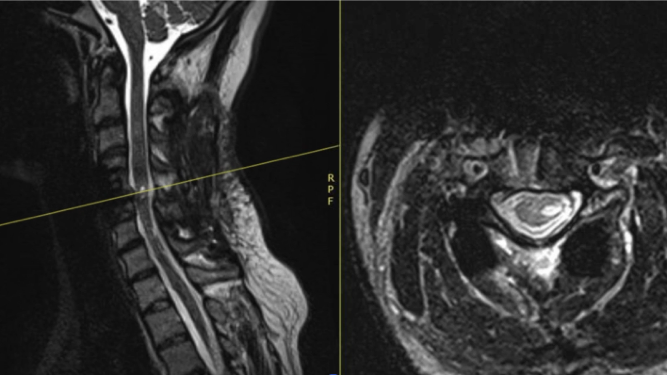 Nerve Transfer for Wrist Extension in C5-C8 Brachial Plexus Injury ...