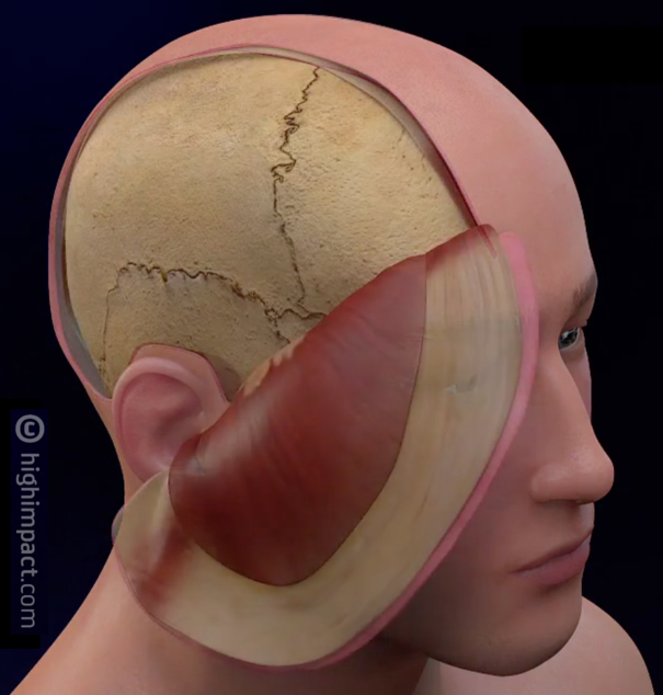 right-decompressive-hemicraniectomy-for-acute-traumatic-subdural