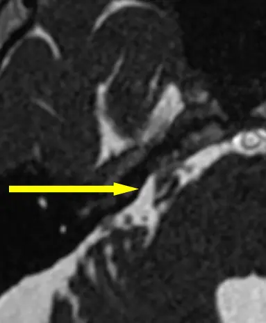 Fully Endoscopic Right Retrosigmoid Craniotomy For Microvascular ...