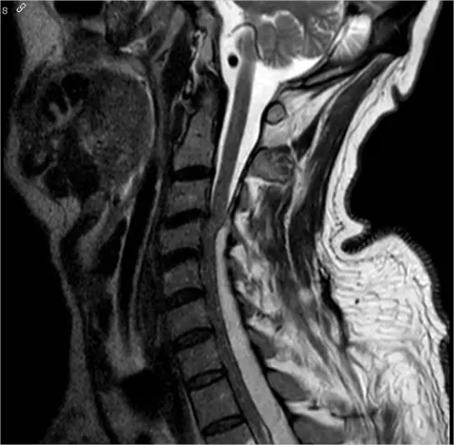 Extensive Epidural Spinal Abscess - cns.org