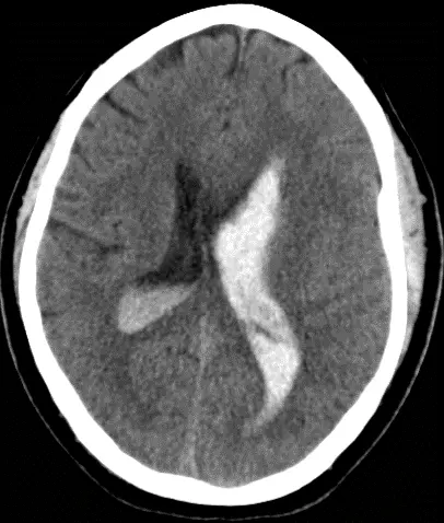 Intraventricular Hemorrhage - Cns.org