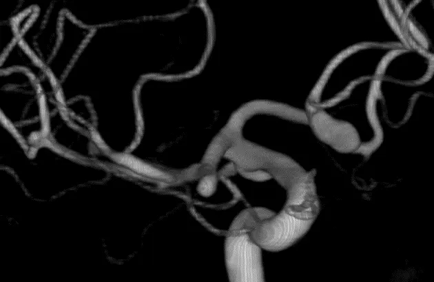 Right Modified Orbitozygomatic Craniotomy For AComm And MCA Aneurysms ...