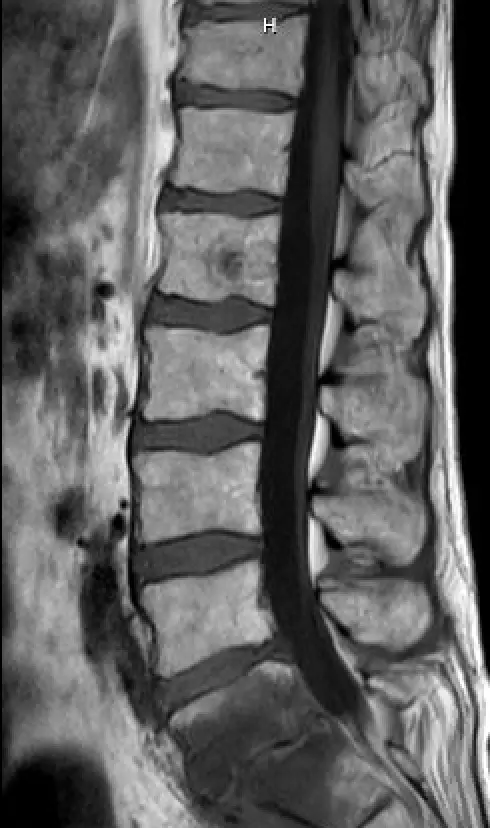 Transfacet transforaminal lumbar interbody fusion for treatment of L5 ...