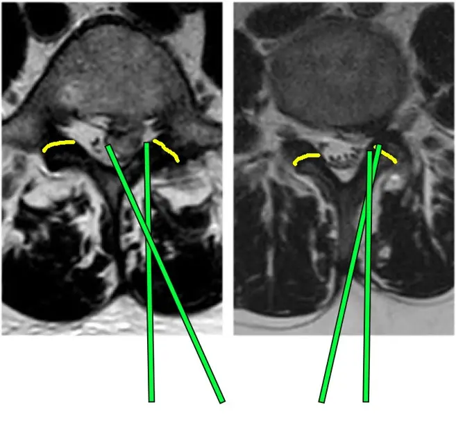 Interlaminar Endoscopic Discectomy For Large Left Paracentral L5 S1