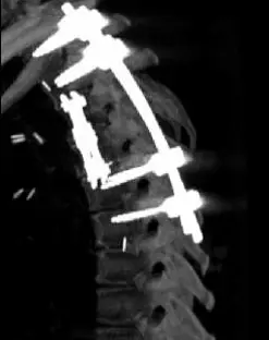 Transthoracic Corpectomies for Tumor Resection and Vertebral Body ...