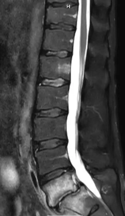 Transfacet Transforaminal Lumbar Interbody Fusion For Treatment Of L5