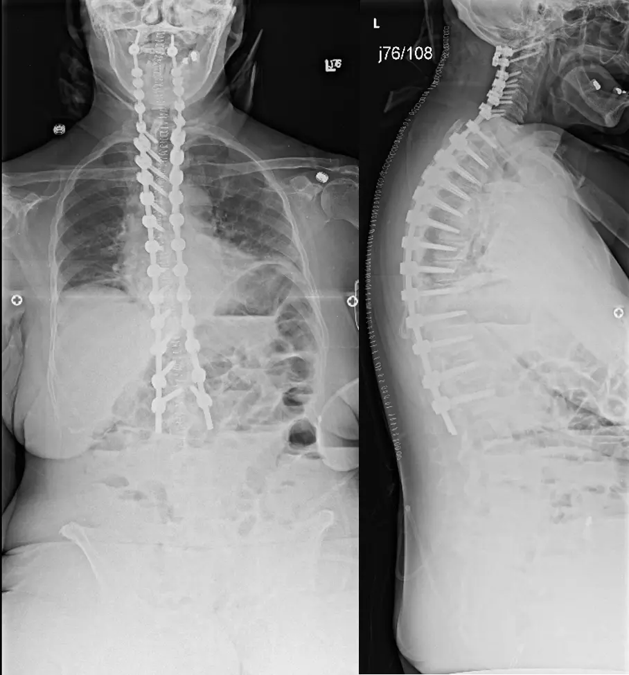 Chin-on-chest deformity in female with cervicothoracic kyphosis - cns.org