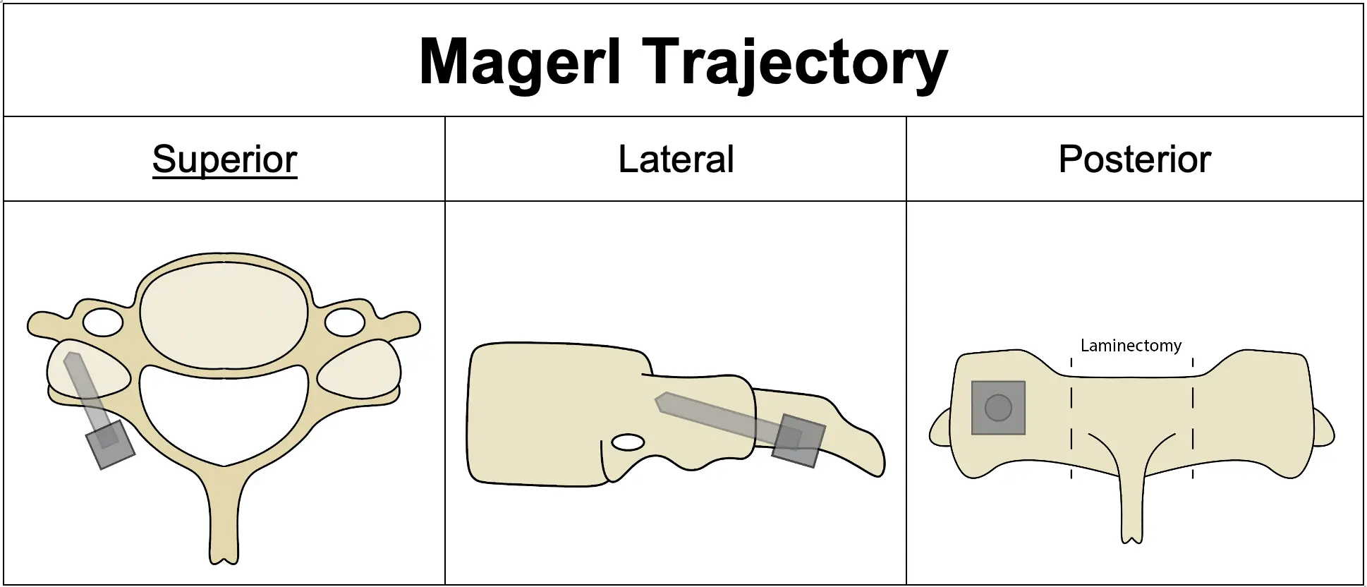 Posterior Cervical Laminectomy And Fusion 5651