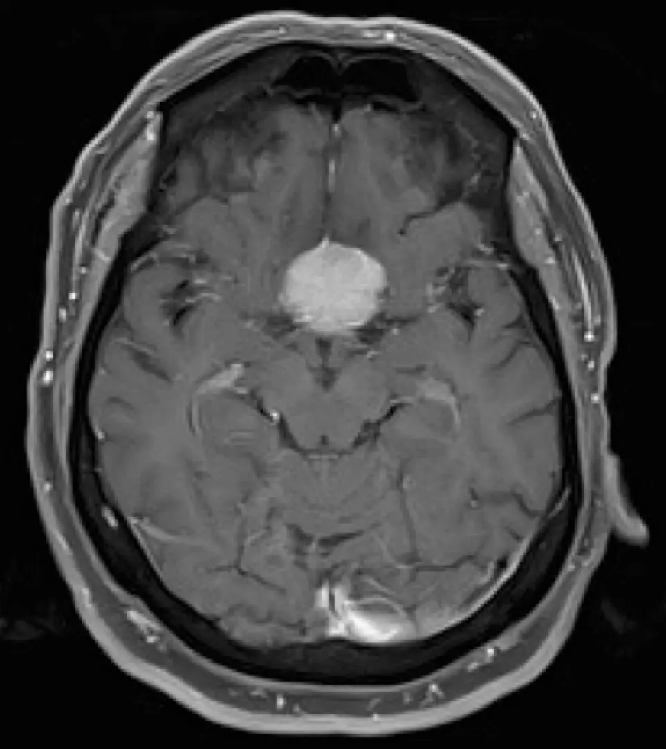 Right Frontotemporal Craniotomy for Resection of Tuberculum Sella ...